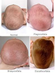 Plagiocefalia